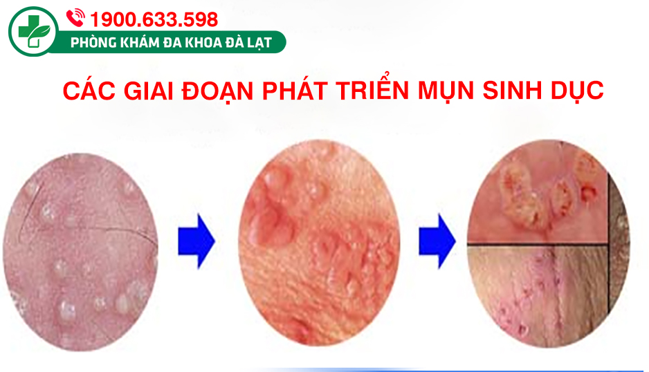 VÙNG KÍN NỔI NỐT CÓ MỦ: NGUYÊN NHÂN, DẤU HIỆU VÀ CÁCH XỬ LÝ